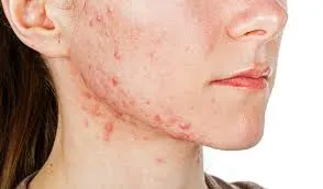 Hormonal Acne