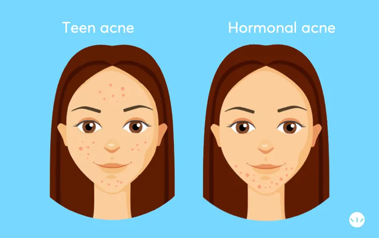 Hormonal Acne