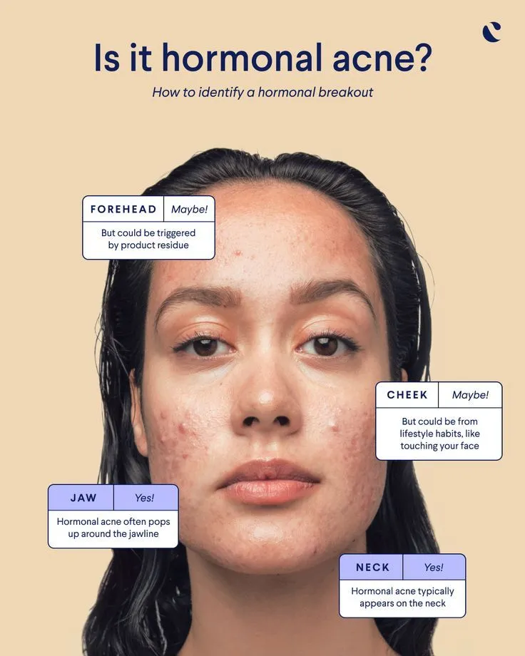 Hormonal Acne