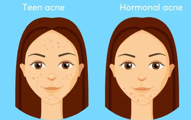 Natural remedies for hormonal acne, featuring ingredients like turmeric, honey, aloe vera, and tea tree oil, displayed on a wooden surface with a calming aesthetic